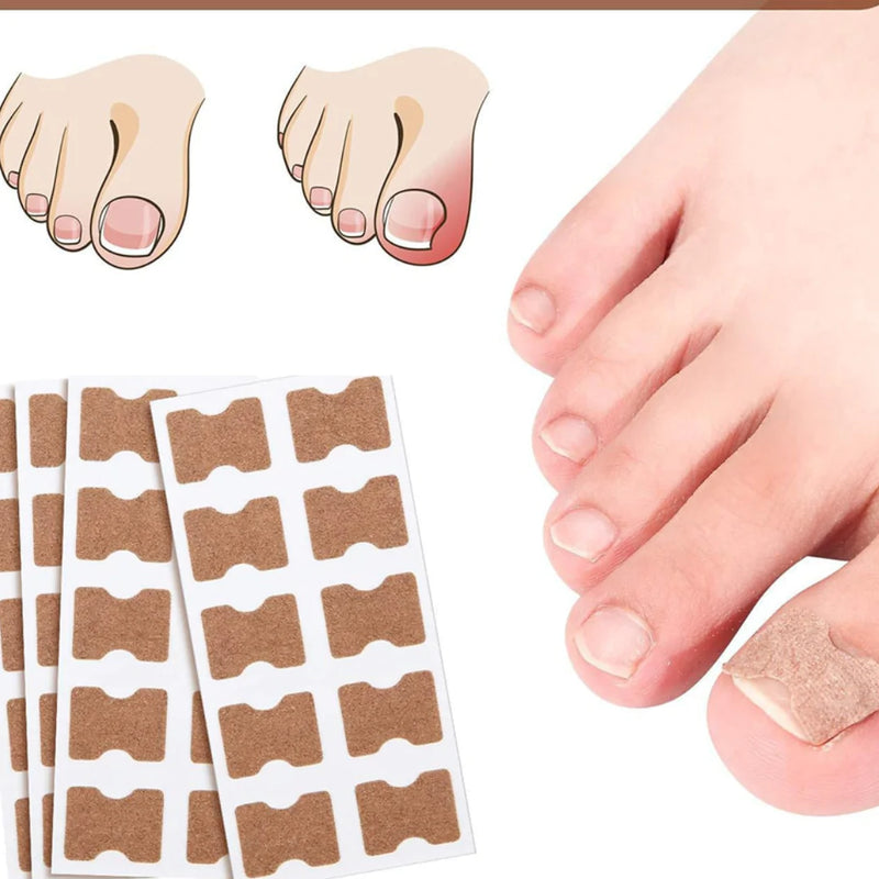 Adesivo Corretor De Unha Encravada