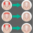 Adesivo Corretor De Unha Encravada